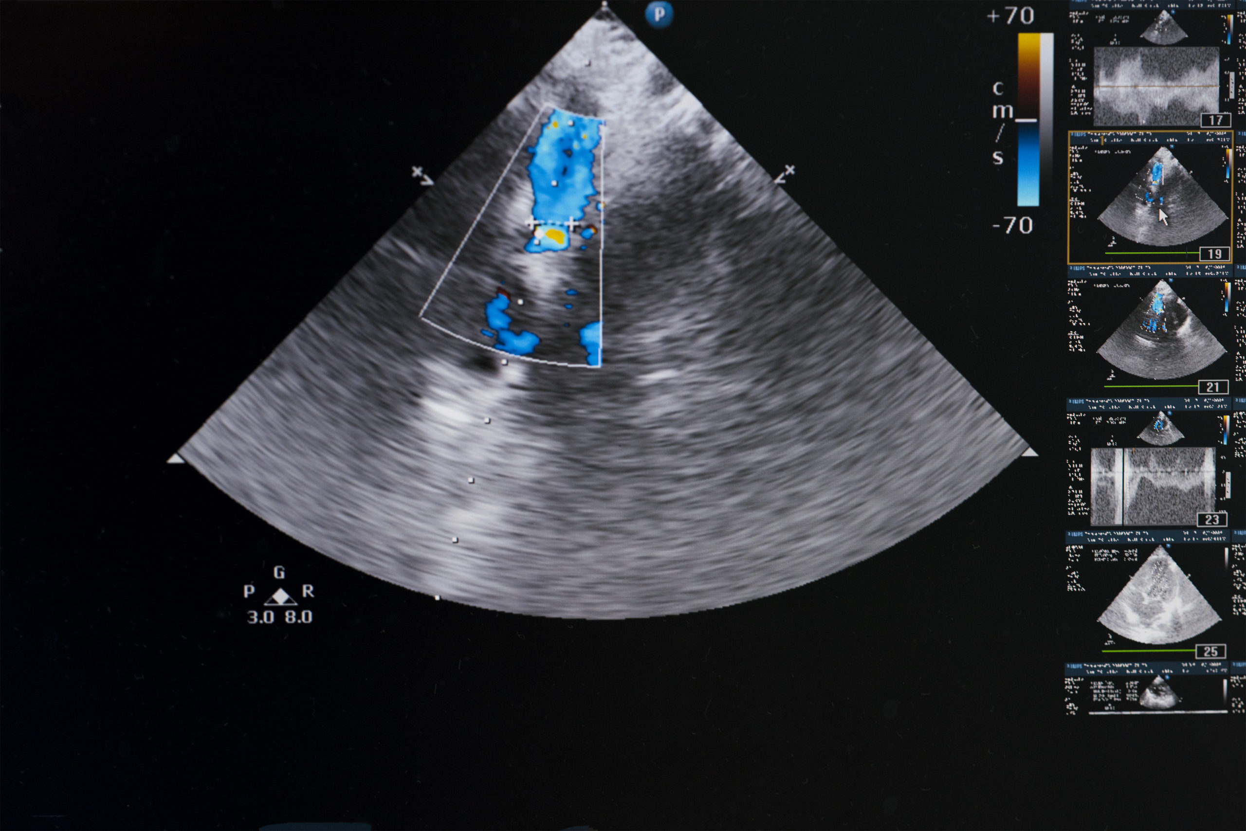 A picture of an ultrasound image showing the location of the heart.